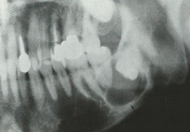 含歯性嚢胞
