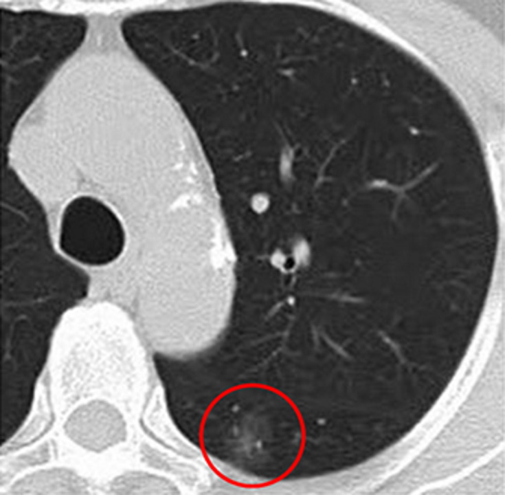CTで発見された早期肺がん