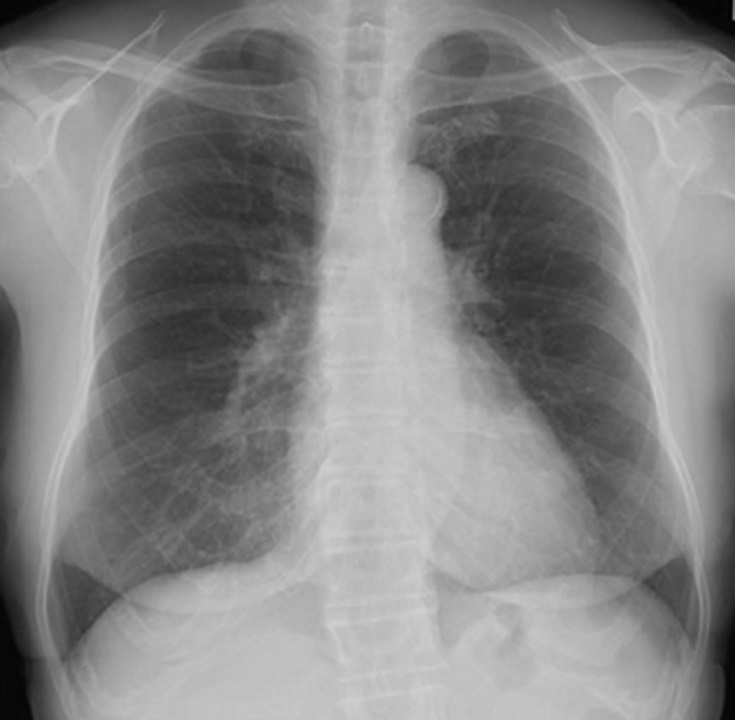 胸部単純X線写真では見えない
